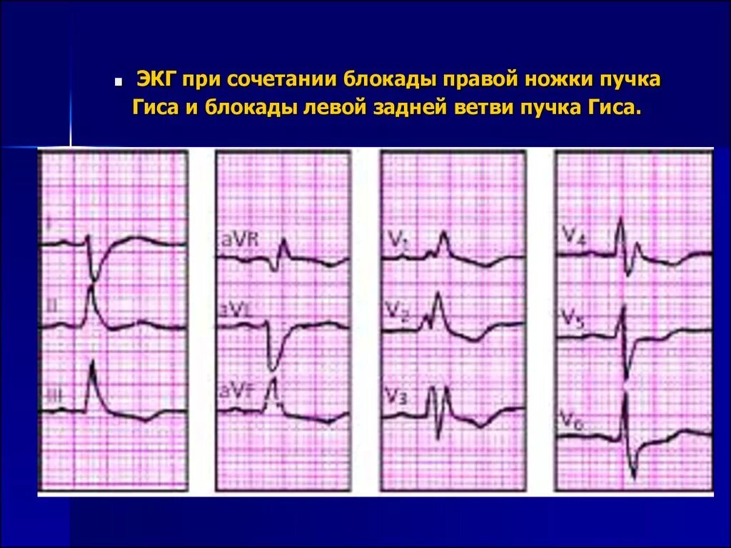 Блокада ПНПГ И задней ветви ЛНПГ на ЭКГ. Блокада ПНПГ на ЭКГ. Полная блокада правой ветви пучка Гиса. Блокада ЛНПГ на ЭКГ. Блокада левого и правого пучка гиса