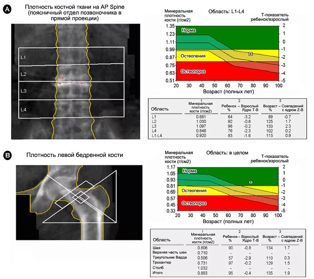 Денситометрия тазобедренных суставов и поясничного отдела позвоночника. Рентген денситометрия расшифровка. Расшифровка денситометрии бедренной кости. Денситометрия т критерий норма. Остеоденситометрия рентген расшифровка.