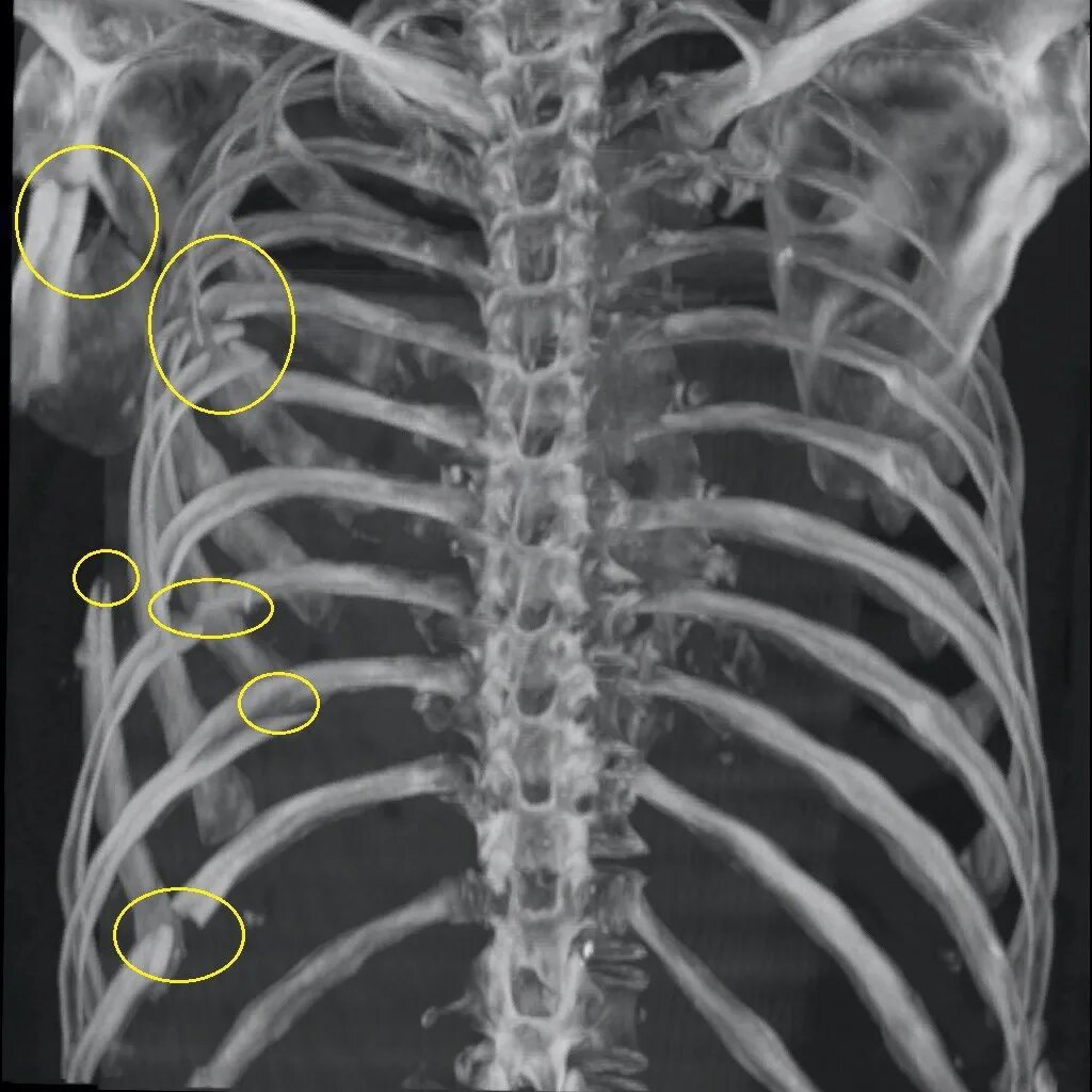 Трещины на грудном. Грудина перелом рентген. Рентген грудной клетки перелом ребер. Перелом 10 ребра рентген. Рентген ребер грудной клетки.