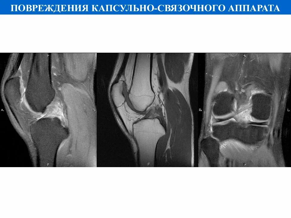 Разрыв капсульно связочного аппарата. Частичное повреждение капсульно-связочного аппарата. Повреждение капсульного связанного аппарата. Травма капсульно-связочного аппарата коленного сустава.