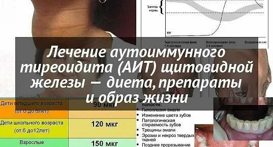 Лечение эутиреоза щитовидной железы у женщин. Аутоиммунный тиреоидит. Тиреоидит щитовидной железы что это такое. Аутоиммунный тиреоидит щитовидной железы симптомы. Симптомы при аутоиммунном тиреоидите.