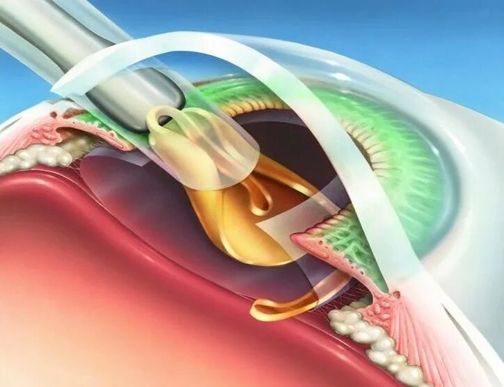 Операция катаракта замена хрусталика отзывы. Ультразвуковая факоэмульсификация катаракты. Факоэмульсификация катаракты с имплантацией ИОЛ. Факоэмульцификация катаракта. Ультразвуковое хирургия катаракты - факоэмульсификация.