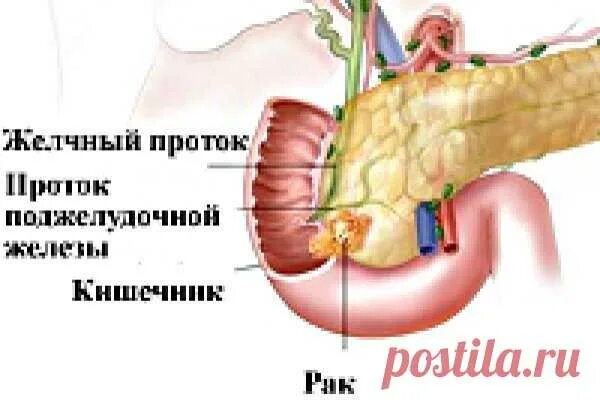 Симптомы забитых желчных протоков. Опухоль головки поджелудочной железы мкб. Резекция поджелудочной железы операция. Операции при опухоли головки поджелудочной железы. Опухоли желчных протоков и поджелудочной железы.