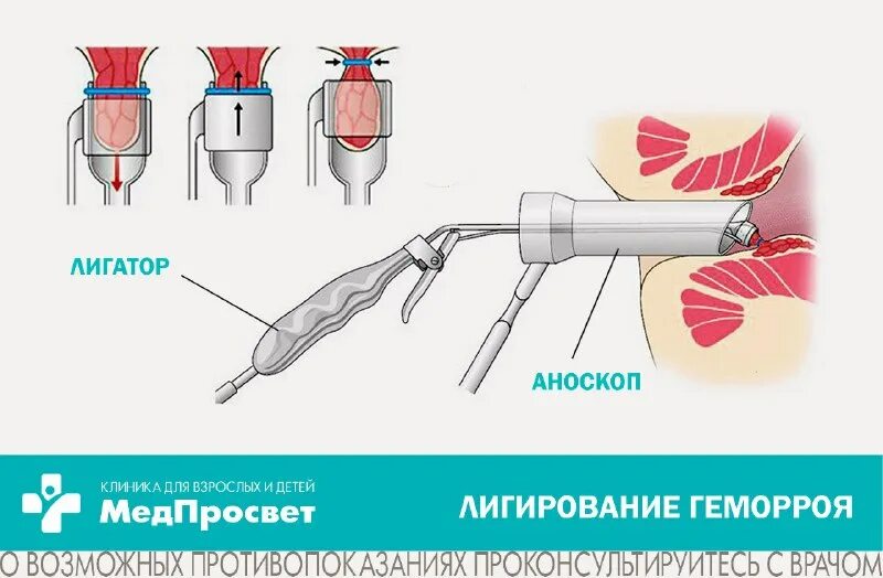 Латексное лигирование геморроидальных узлов. Лигирование внутренних геморроидальных узлов. Легирование эндоскопическое. Легирование геморроидальных узлов. Латексные кольца для лигирования геморроидальных узлов.