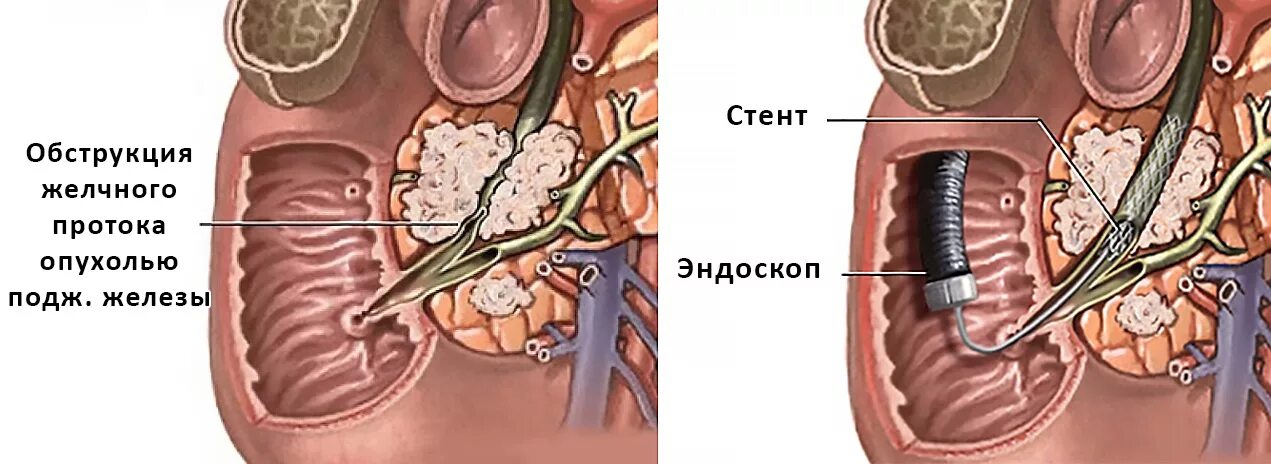 Стент желчного протока