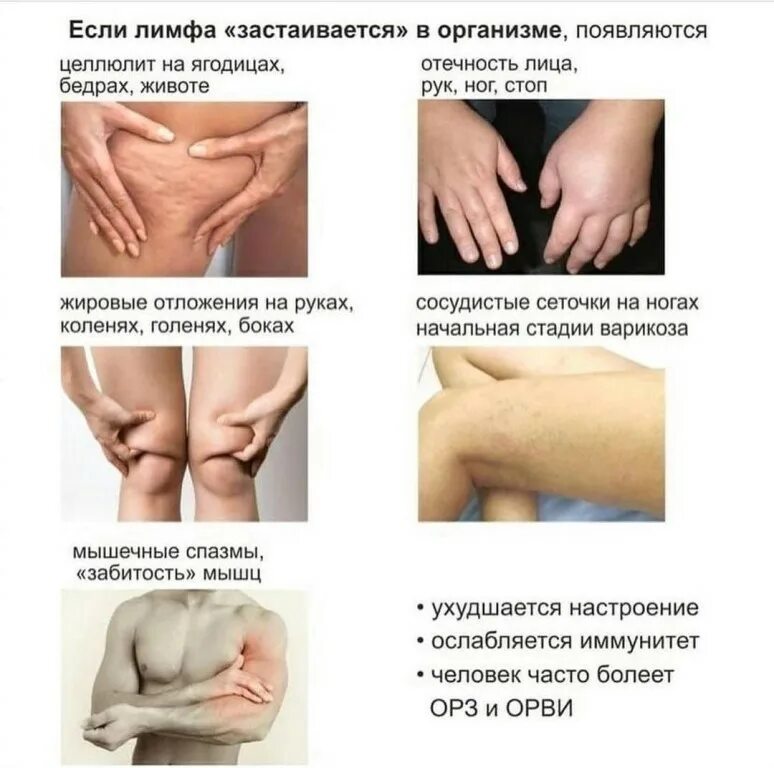 Нарушена лимфа. Лимфатическая система застой лимфы. Нарушения лимфообращения классификация. Каковы механизмы возникновения лимфатической недостаточности. Лимфостаз застой лимфы.