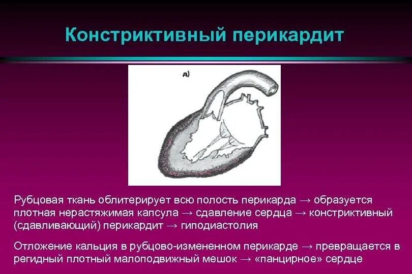 Тампонада перикарда рентген. Ревматический перикардит. Констриктивный туберкулезный перикардит. Воспаление околосердечной сумки. Фибринозный перикардит эхокг.