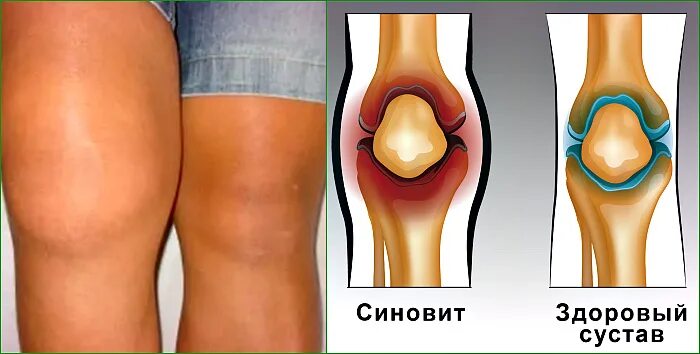 Синовит колена коленного сустава. Синовит коленного сустава синовит. Травматический синовит коленного сустава. Артрит коленного сустава в домашних условиях