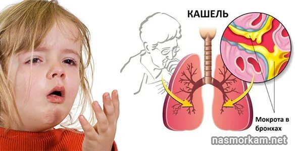 Мокрый кашель сопли. Влажный кашель у ребенка. мокрый кашель с мокротой. влажный кашель с мокротой у ребенка.