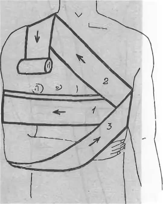 Порядок наложения повязки Дезо. Повязка Дезо бинтом. Повязка Дезо алгоритм. Повязка Дезо показания.