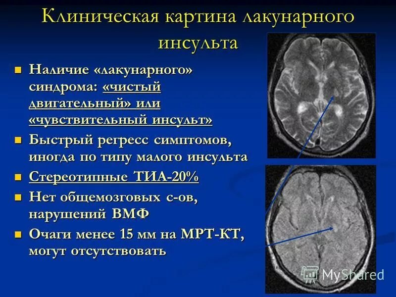 Клинический инсульт лечение. Лакунарный инсульт симптомы. Атеротромботический ишемический инсульт. Клинические симптомы ишемического инсульта головного. Лакунарный ишемический инсульт симптомы.