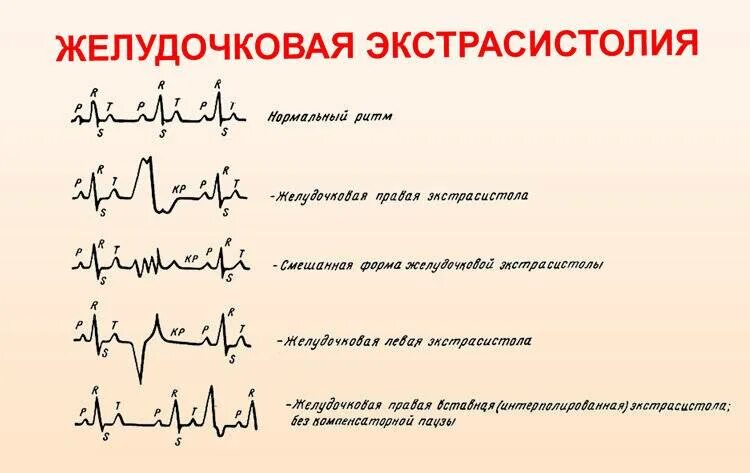 Желудочковые экстрасистолы на ЭКГ. Нарушения ритма на ЭКГ экстрасистолы. ЭКГ монотопные желудочковые экстрасистолы. Ранние желудочковые экстрасистолы на ЭКГ. Типы желудочковых экстрасистол