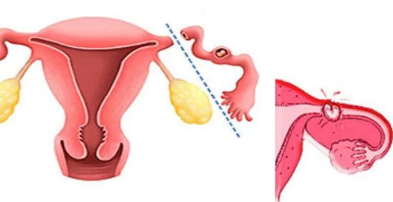 Маточные трубы удаление месячные. Внематочная беременность операция. Внематочная беременность лапароскопия. Трубная беременность лапароскопия.