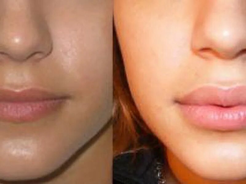 Увеличение губ до и после отзывы. Губы накаченные гиалуроновой кислотой 1 мл. Накаченные губы до и пос.