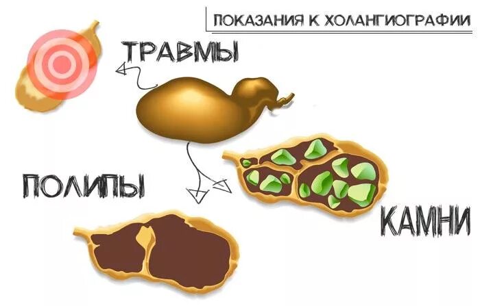 Лечение полипов в желчном пузыре народными средствами. Лекарство от полипов в желчном. Полипоз желчного пузыря. Аденоматозный полип желчного пузыря.