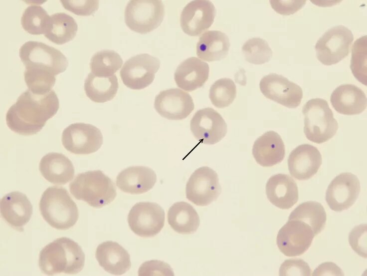Free picture: plasmodium vivax, ring, stippling, erythrocyte