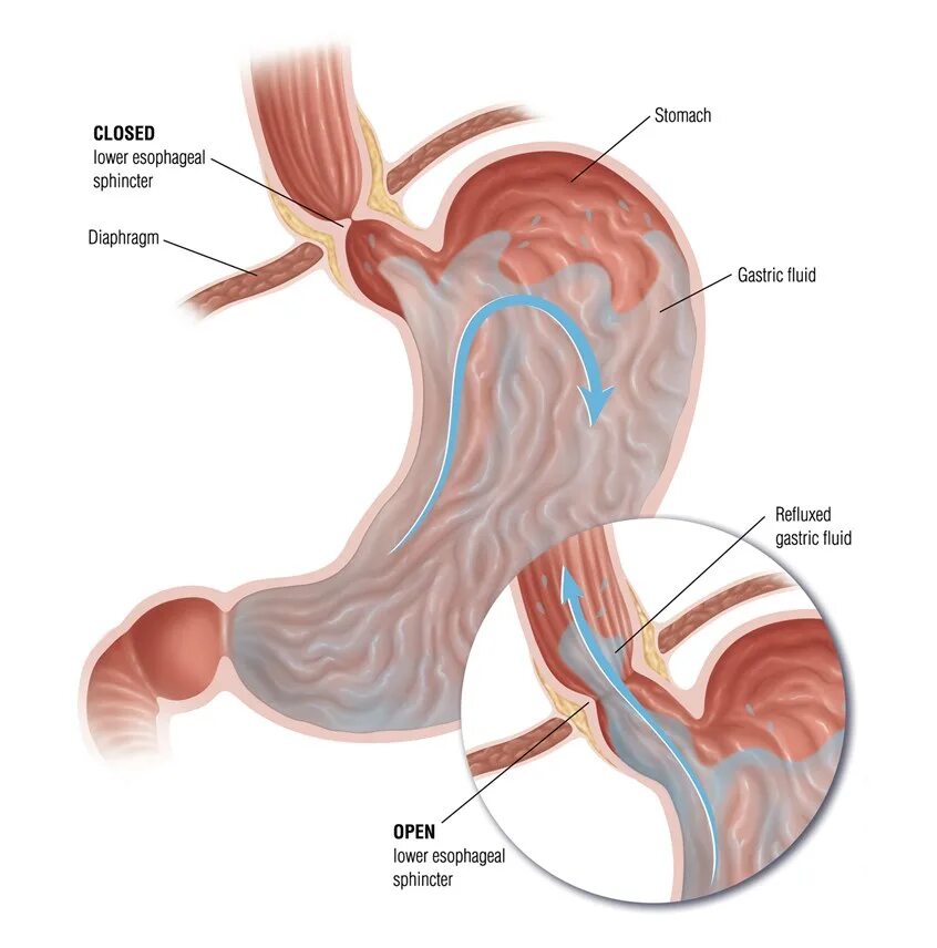 Заброс кислоты из желудка в пищевод. Гастроэзофагеальная гастроэзофагеальный рефлюкс. Физиологический гастроэзофагеальный рефлюкс. Гастроэзофагеальный сфинктер.