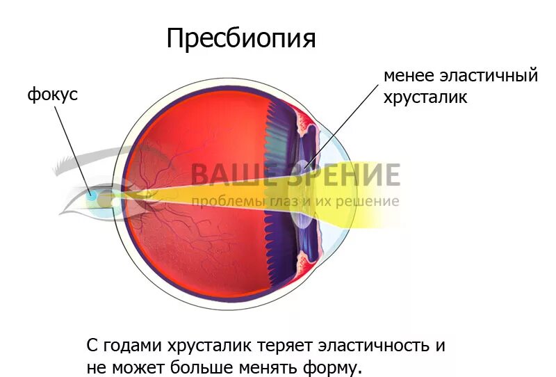 Почему у людей пожилого возраста развивается дальнозоркость. Пресбиопия. Пресбиопия (возрастная дальнозоркость). Коррекция зрения при пресбиопии. Изменения хрусталика при пресбиопии.