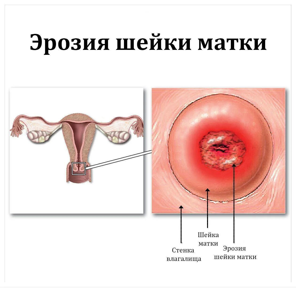 Влагалище Нерожавшей Женщины