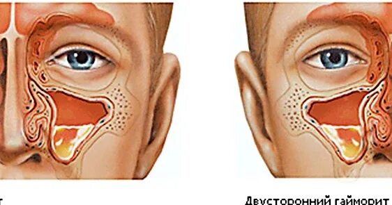 Гнойные выделения из носа при синусите. Гнойный гайморит сопли. Из ноздри течет вода