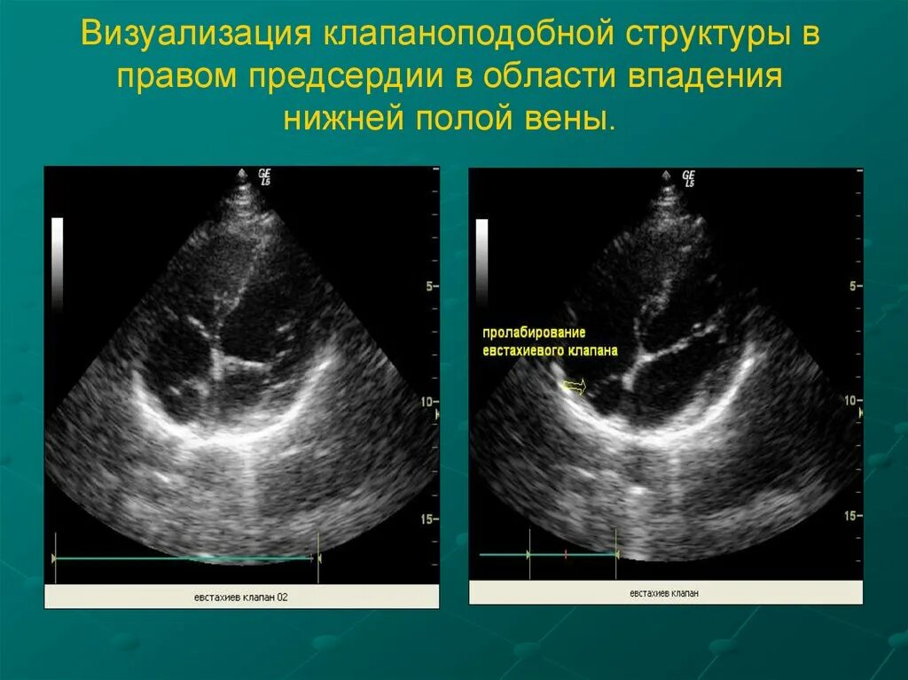 Образование левого предсердия. Евстахиева заслонка ЭХОКГ. Клапан нижней полой вены в правом предсердии. УЗИ структура сердца. Образования в правом предсердии.