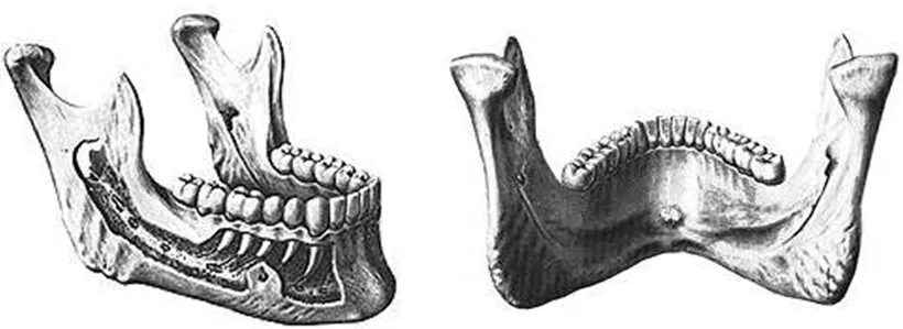 Нижняя челюсть кость анатомия. Нижняя челюсть анатомия Синельников. Нижняя челюсть Синельников. Альвеолярный гребень альвеолярного отростка. Нижняя челюсть с другими костями черепа