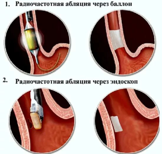 Операция рча что это такое. Радиочастотная катетерная абляция. пищевод барретта абляция. радиочастотная абляция пищевода. радиочастотная абляция рча.