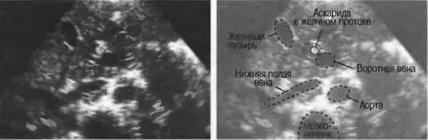 Паразиты в желчном