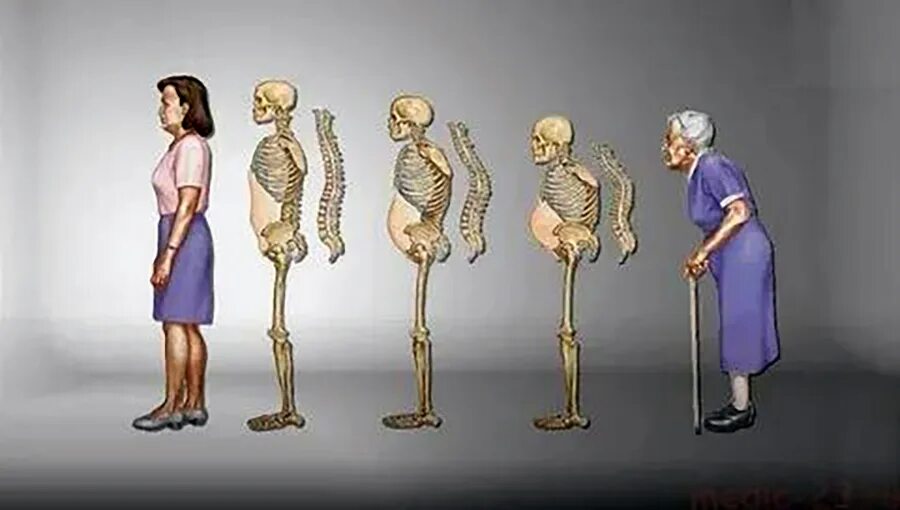 Физические возрастные изменения. Кости человека остеопороз. Старческий остеопороз.