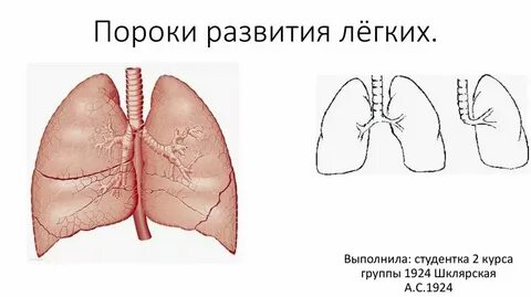 Пороки бронхолегочной системы