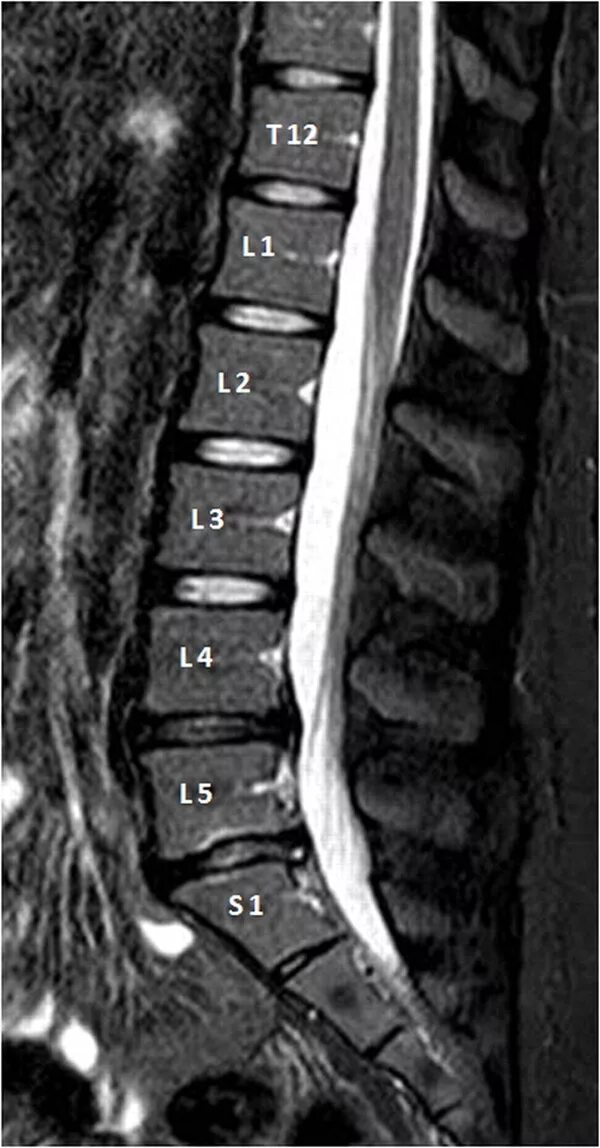 Протрузия позвоночника l2-l3. Диски l5-s1 в позвоночнике. Протрузии дисков l3-l5. Диски l4 s1 позвоночника.
