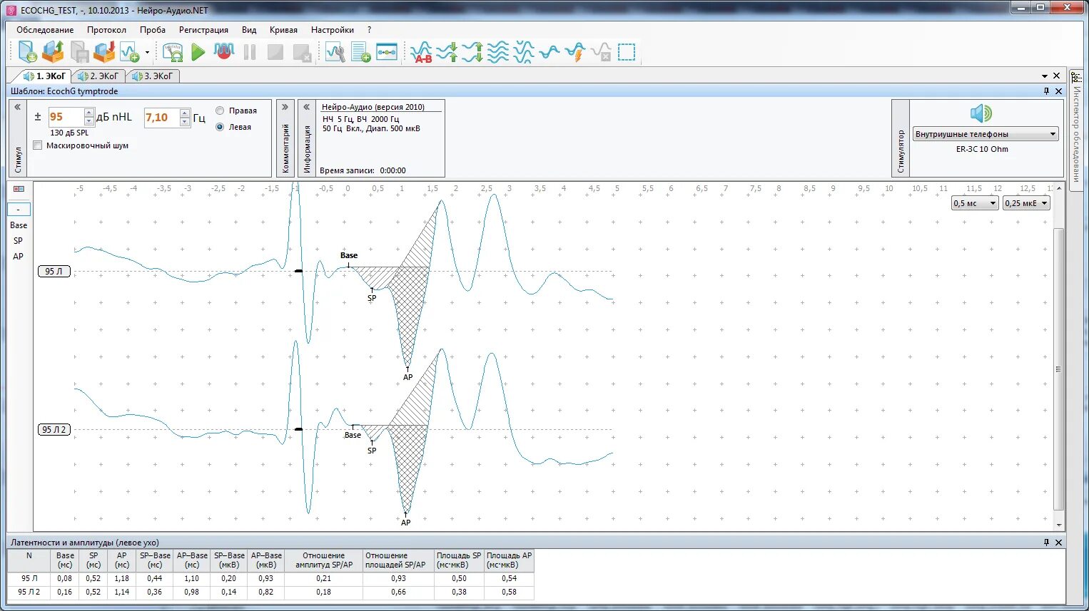Электрокохлеография при болезни Меньера. Нейро-аудио Нейрософт. Нейрософт КСВП. Экстратимпанальная электрокохлеография. Нейро тесты