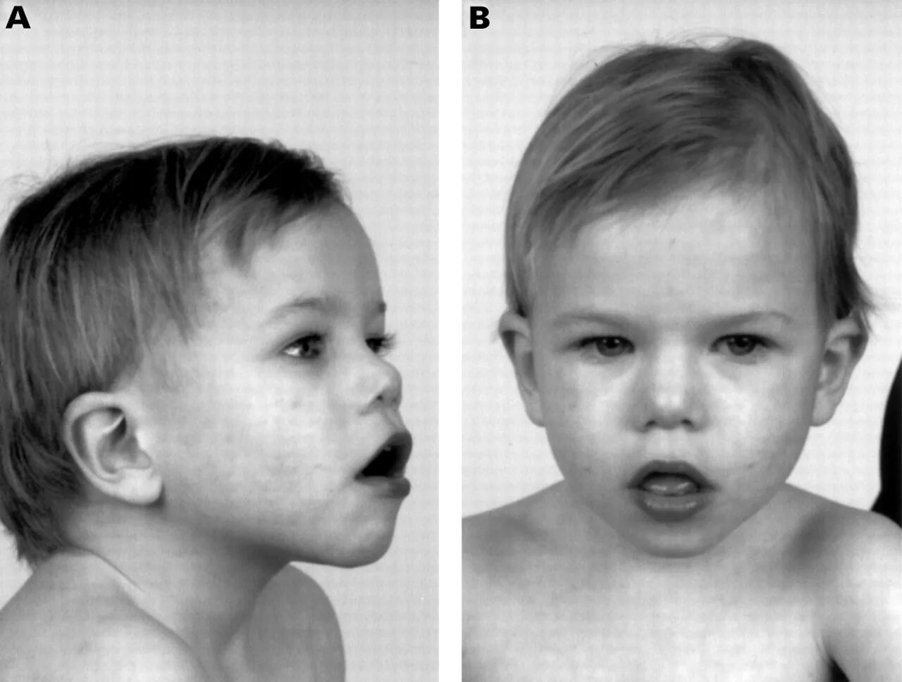 Синдром вольфа-хиршхорна (делеция 4р-). Частичный синдром. Частичный синдром. Синдром частичной трисомии по 9. Частичный синдром.