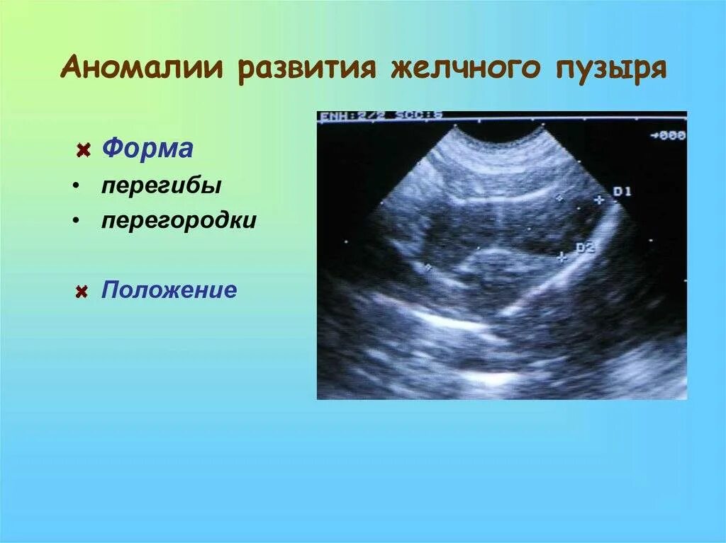 Эхопризнаки желчного пузыря. Врожденный перегородка желчного пузыря. Аномалии развития желчного пузыря. Аномалия формы желчного пузыря. Аномалии развития желчного пузыря на УЗИ.