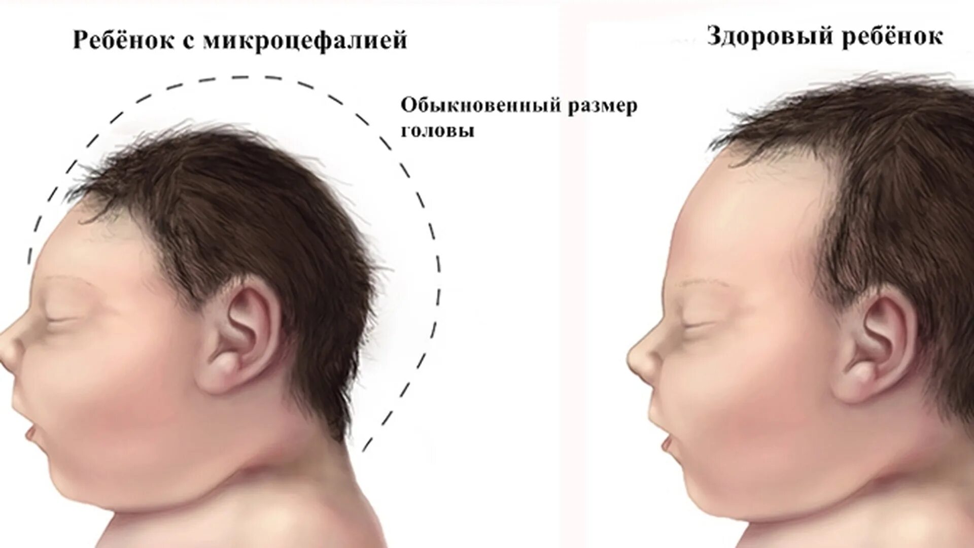 Микроцефалия причины. Вирус Зика микроэнцефалия.