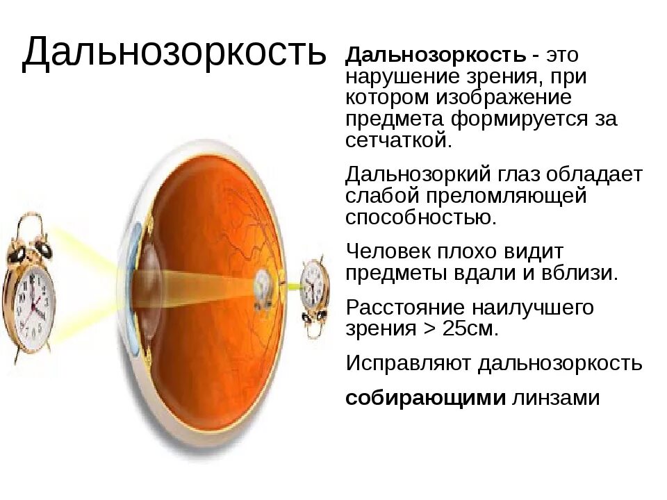 Зрение при гиперметропии. Дефекты зрения дальнозоркость. Глаз при гиперметропии. Гиперметропия или дальнозоркость. Близко видеть далеко плохо
