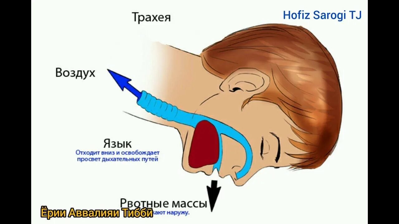 Рвотный рефлекс при чистке. Аспирация рвотных масс. Рефлекторная рвота. Аспирация рвотных масс дыхательных путей.