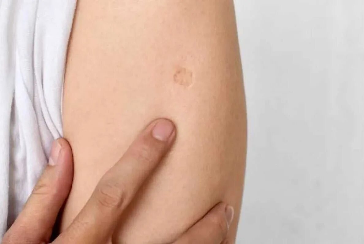 Плечо надплечье. Отметка на плече. След от прививка от оспы. Шрам от прививки на плече. След на руке от прививки бцж.