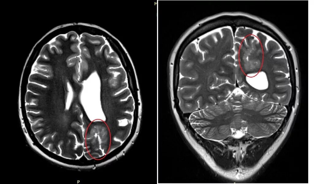 Очаги в коре головного мозга. Полимикрогирия головного мозга мрт. Кт и мрт при эпилепсии. Мрт головного мозга при эпилепсии. Фокальная дисплазия мрт.