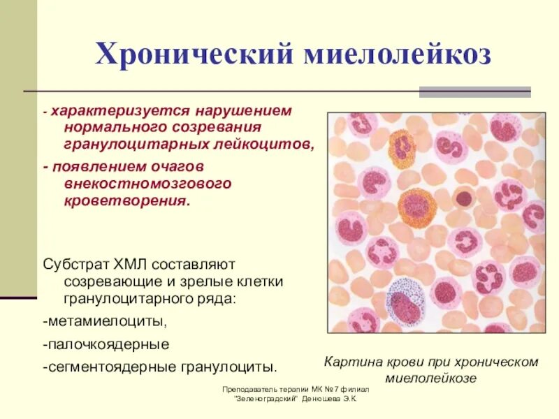 Анализ крови на мозг. Хронический миелолейкоз показатели лейкоцитов. Миелоцитарный лейкоз картина крови. Хронический миелоидный лейкоз картина крови. Хронический миелолейкоз клинический диагноз.