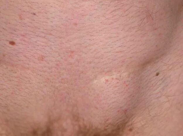 боль в бедренном суставе. лимфоузел на ноге воспаление. колит между ног. отрубевидный лишай, эритразма. колит между ног.