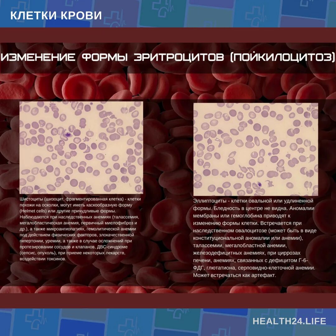 Форма эритроцитов при железодефицитной анемии. Клетки крови эритроциты. Формы эритроцитов в крови при анемии. Картина крови при анемии.