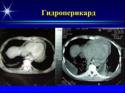 Гидроперикард это