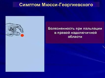 Симптом мюсси георгиевского