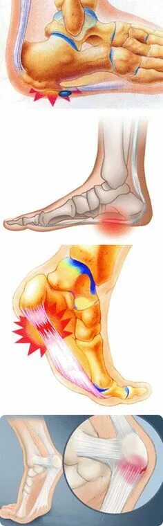 Боль при наступании на пятку. Боль ноет в пятке