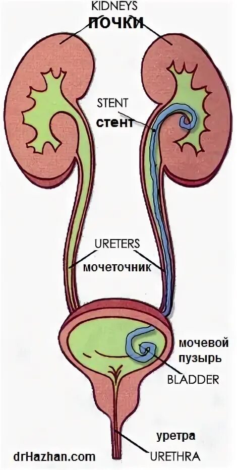 Стент в мочеточнике у женщин. Катетер стент почечный. Стенд для расширения мочеточника. Стент мочеточниковый в почке. Стенд в мочеточнике стент в мочеточнике.