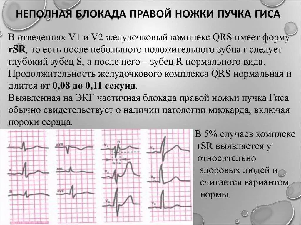 Признаки неполной блокады. Неполная блокада ножек пучка Гиса. Неполная блокада правой ножки пучка Гиса на ЭКГ. Неполная блокада правой ножки на ЭКГ. Правая неполная блокада правой ножки пучка Гиса.