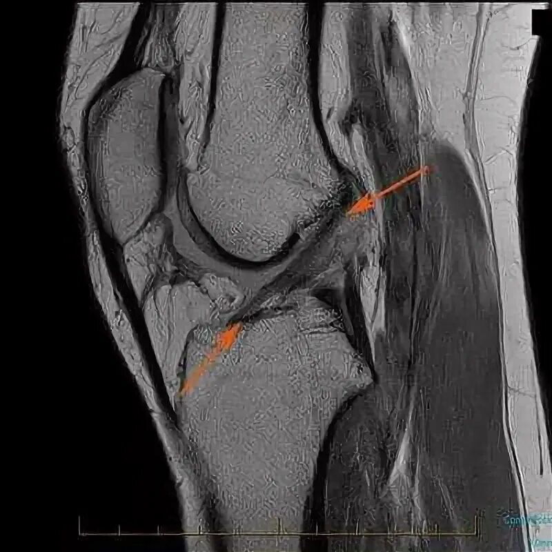Разрыв передней крестообразной связки мрт. Разрыв крестообразной связки на мрт. Разрыв ПКС коленного сустава на мрт. Повреждение передняя крестообразная связка мрт. Полный разрыв передней крестообразной