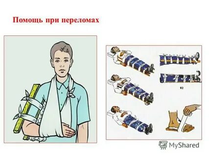 Основная помощь при переломе