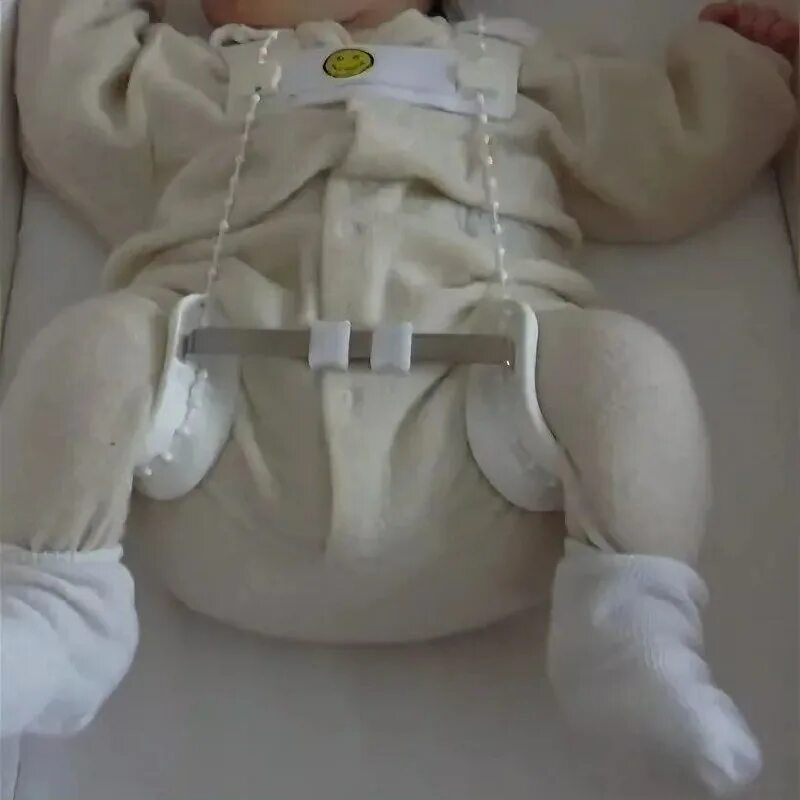 Дисплазия тазобедренных суставов 1. Врожденный вывих бедра широкое пеленание. Можно ли при дисплазии. Можно ли при дисплазии. Дисплазия тазобедренных суставов в 1 год симптомы.